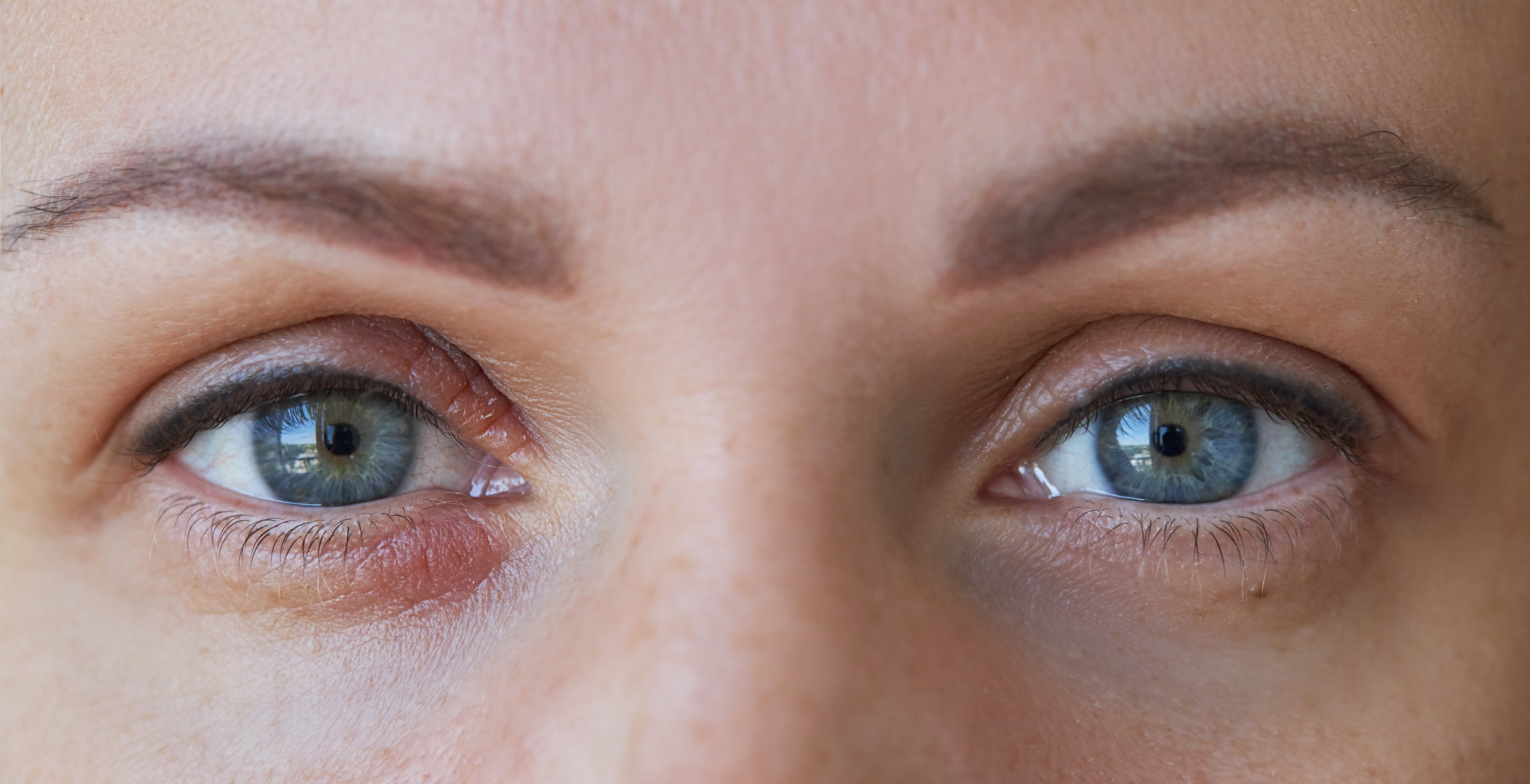 Demodex and eyelid health imagery from Jewel City Optometry