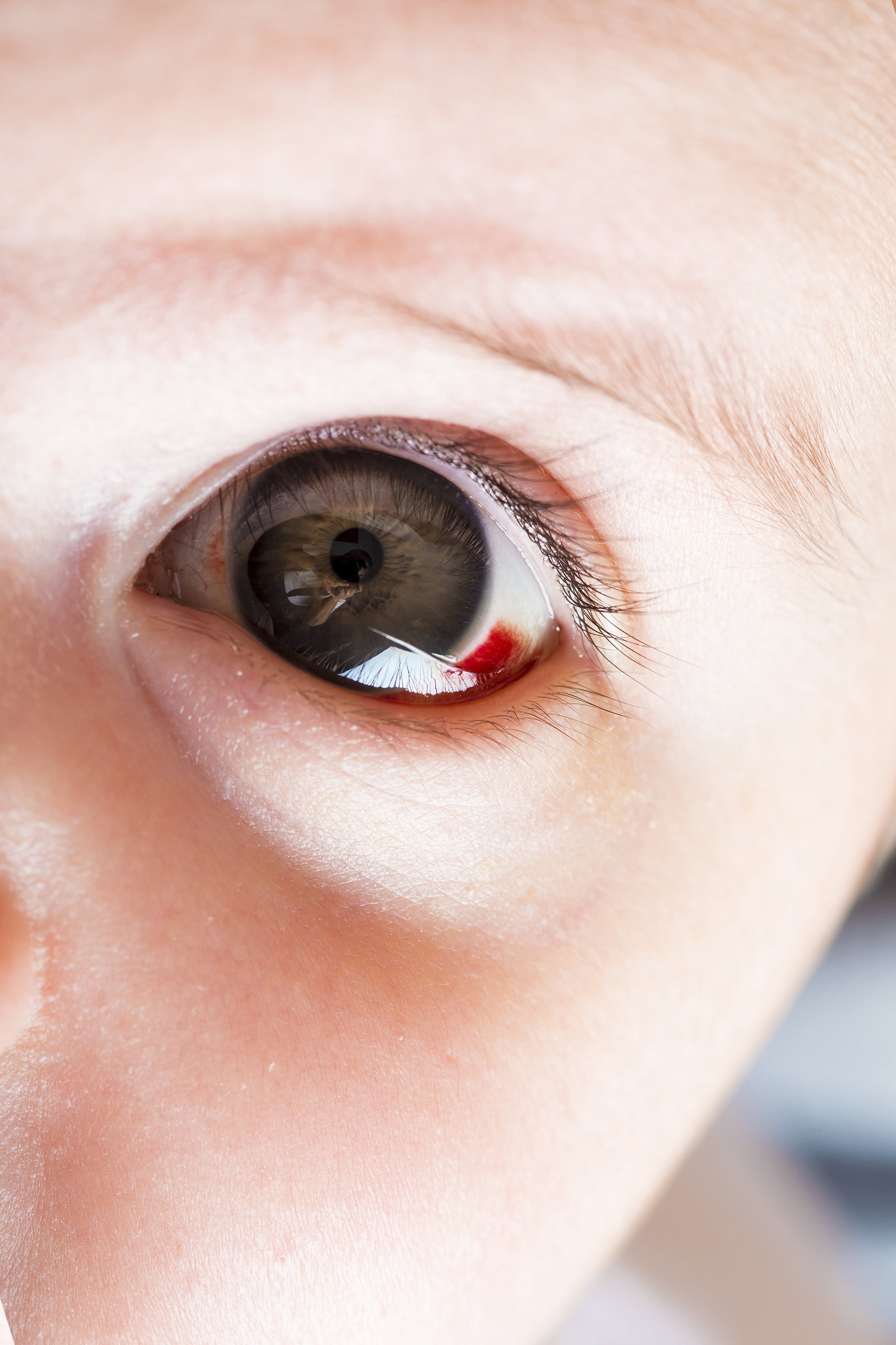 Pink eye care at Jewel City Optometry
