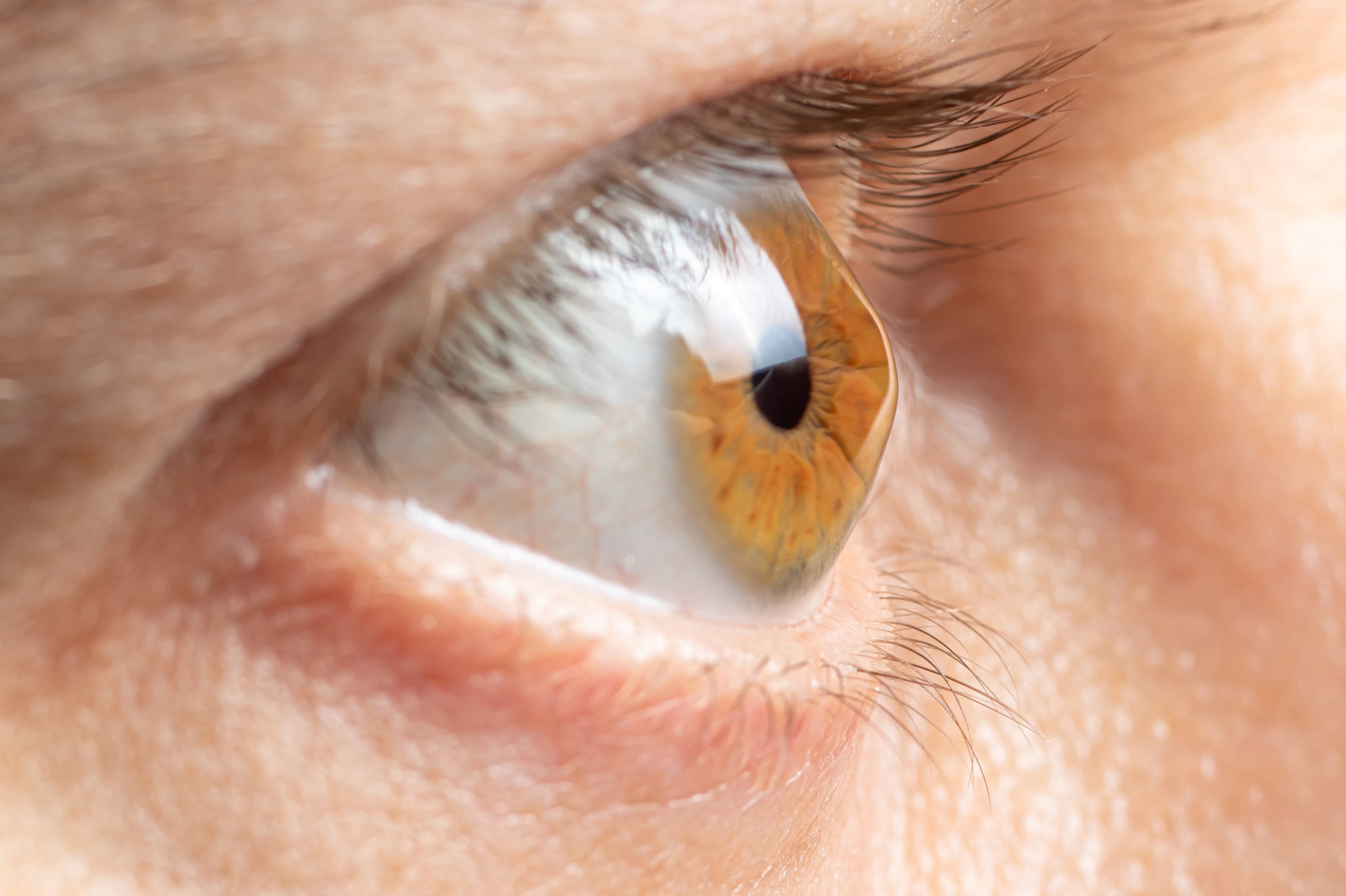 Keratoconus and treatment options illustration from Jewel City Optometry